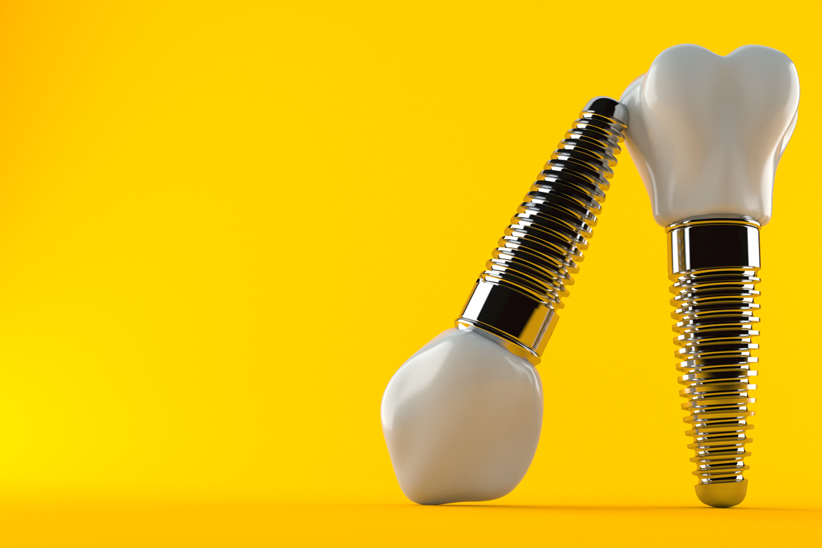 Taking Good Care of Your New Smile: Post-op Oral Care For Dental Implants